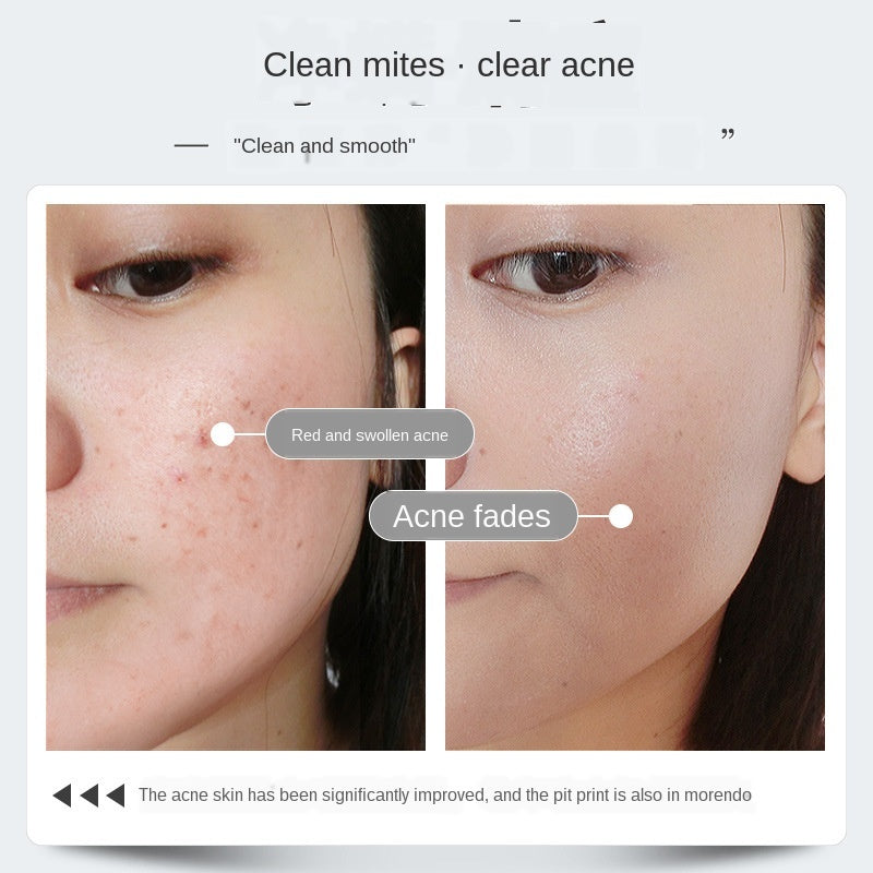 Before and after comparison showing acne improvement using Arts And More Mite Removal Soap